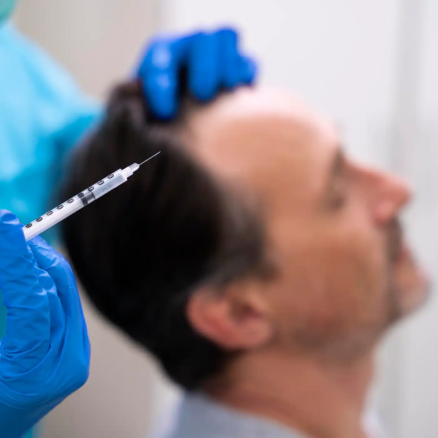 Ein Arzt mit blauen Handschuhen hält eine Spritze bereit, während im Hintergrund ein Mann mit beginnendem Haarausfall entspannt sitzt – die Szene steht symbolisch für eine moderne Stammzellen- oder PRP-Behandlung zur Förderung des Haarwachstums bei männlichem Haarausfall.